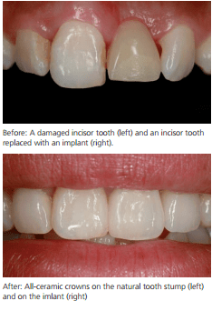 dental-implants-birmingham-dentist dental-implant-birmingham-dentist