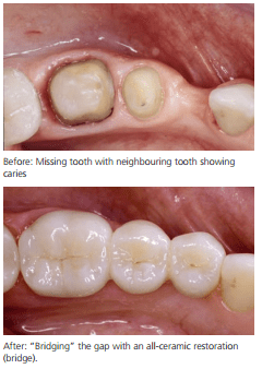 bridge-example-dentists-in-birmingham