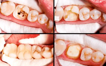 crowns-treatment-dentist-birmingham crowns-treatment-dentist-in-birmingham