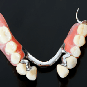 denture-example-City-Dental-Birmingham