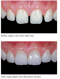 veneer-example-dentist-in-birmingham